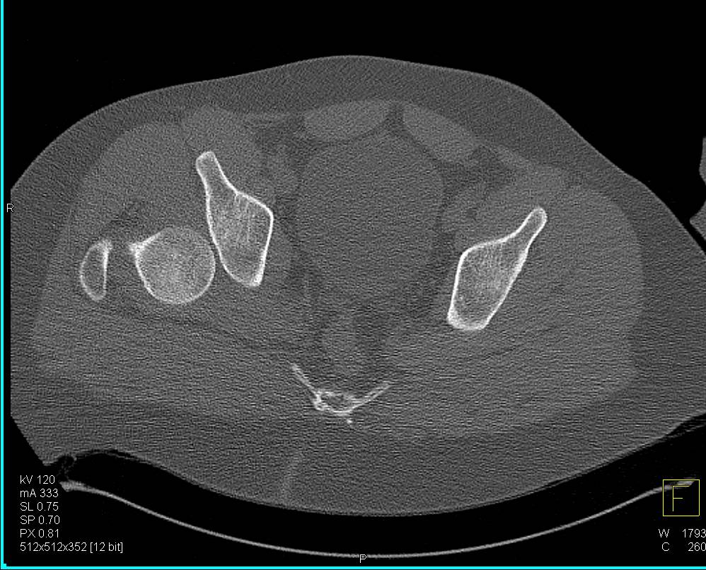 Dislocated Right Hip with Pre and Post Reduction Images - CTisus CT Scan