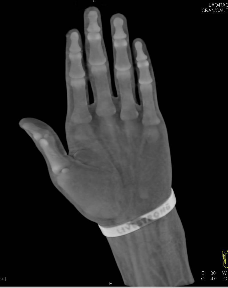 Multiple Carpal Bone Fractures with GSW - CTisus CT Scan