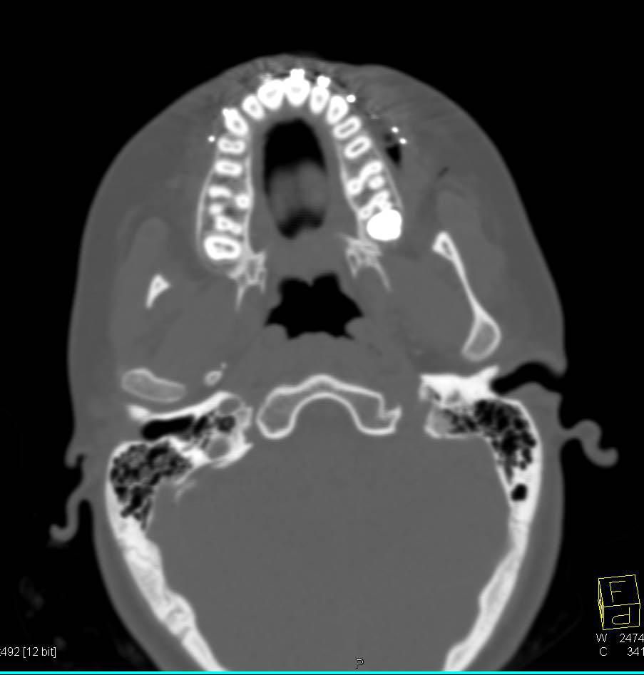 3D Post Repair of Mandibular Fractures - CTisus CT Scan