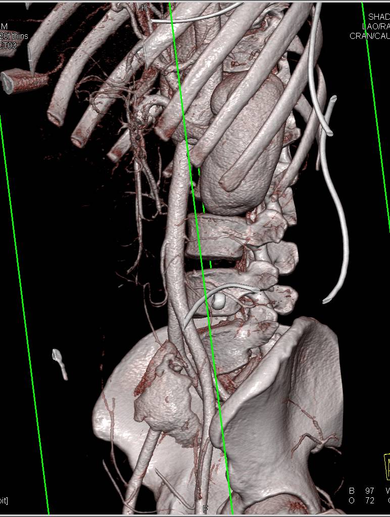 Traumatic Pseudoaneurysm with Active Bleed - CTisus CT Scan