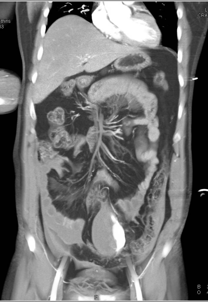 Large Active Bleed in Mesentery Following Trauma - CTisus CT Scan