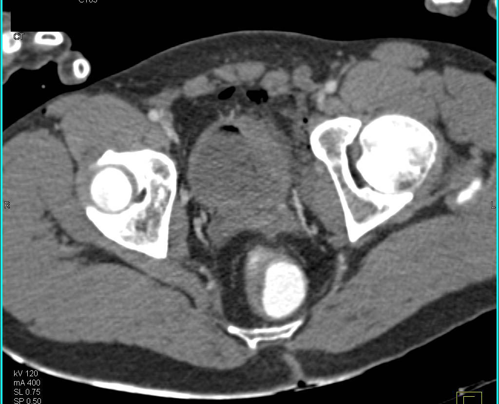 GSW with Pulmonary Trauma and Pelvic Trauma with Bladder Injury - CTisus CT Scan