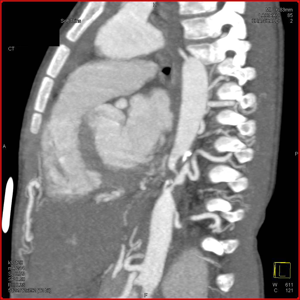 Stenosis Mid Thoracic Aorta of Uncertain Etiology c/w Mid Aortic Syndrome - CTisus CT Scan