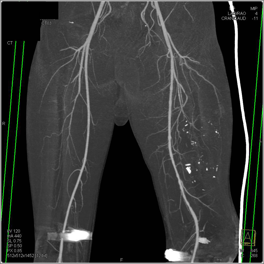 GSW with Femur Fracture but No Vascular Injury - CTisus CT Scan