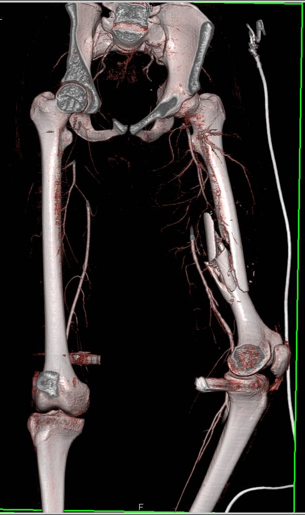 GSW with Femur Fracture but No Vascular Injury - CTisus CT Scan