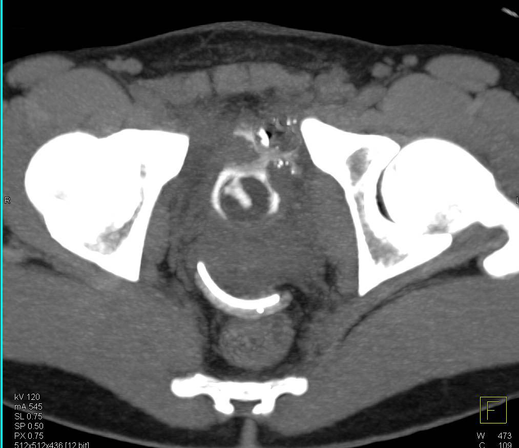 GSW with Symphysis Fracture and Bladder Injury - CTisus CT Scan