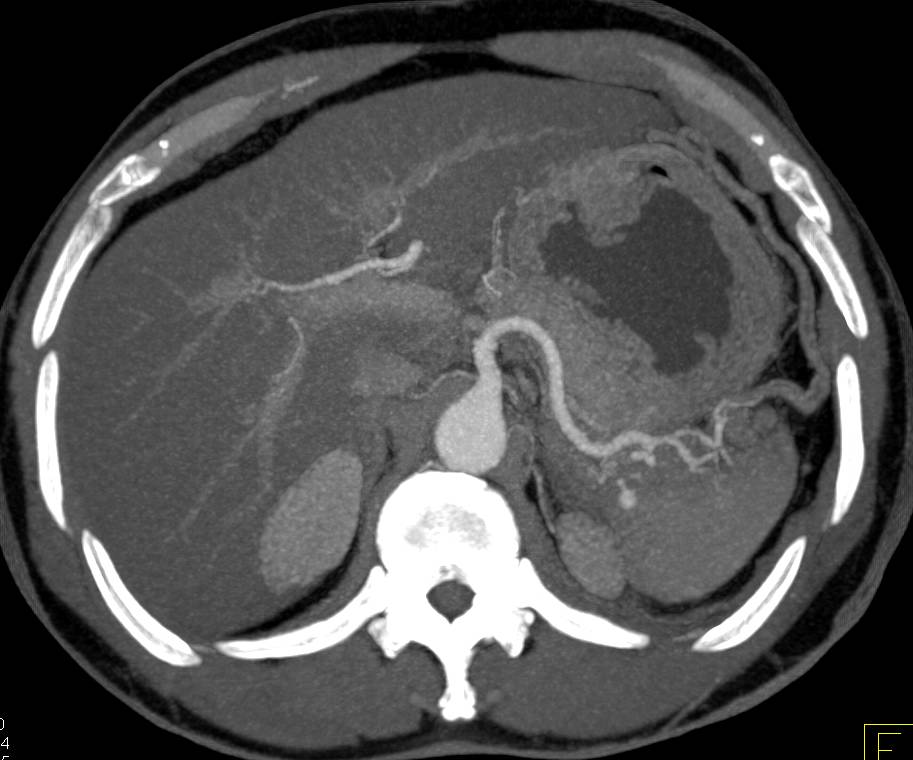 Active Bleed Near Spleen Following Trauma - CTisus CT Scan