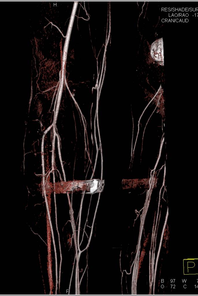CTA Following GSW Without Active Bleed - CTisus CT Scan