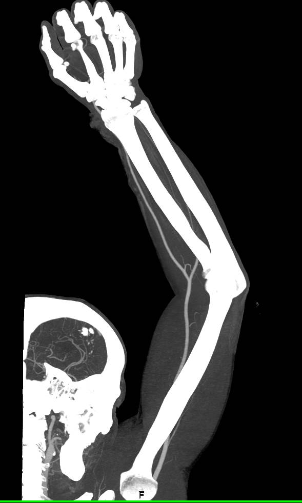 CTA Upper Extremity Without Vascular Injury - CTisus CT Scan