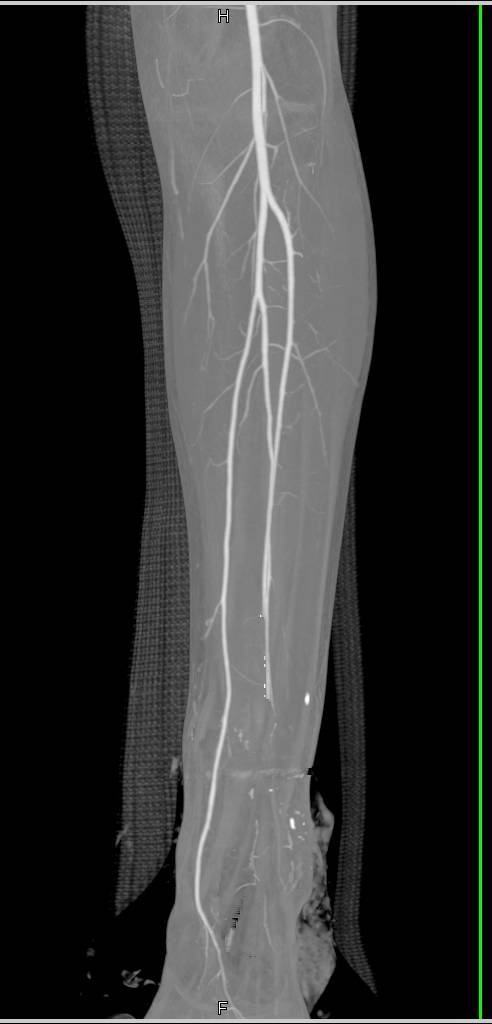 GSW to Calf With Anterior Tibial Artery Occlusion - CTisus CT Scan