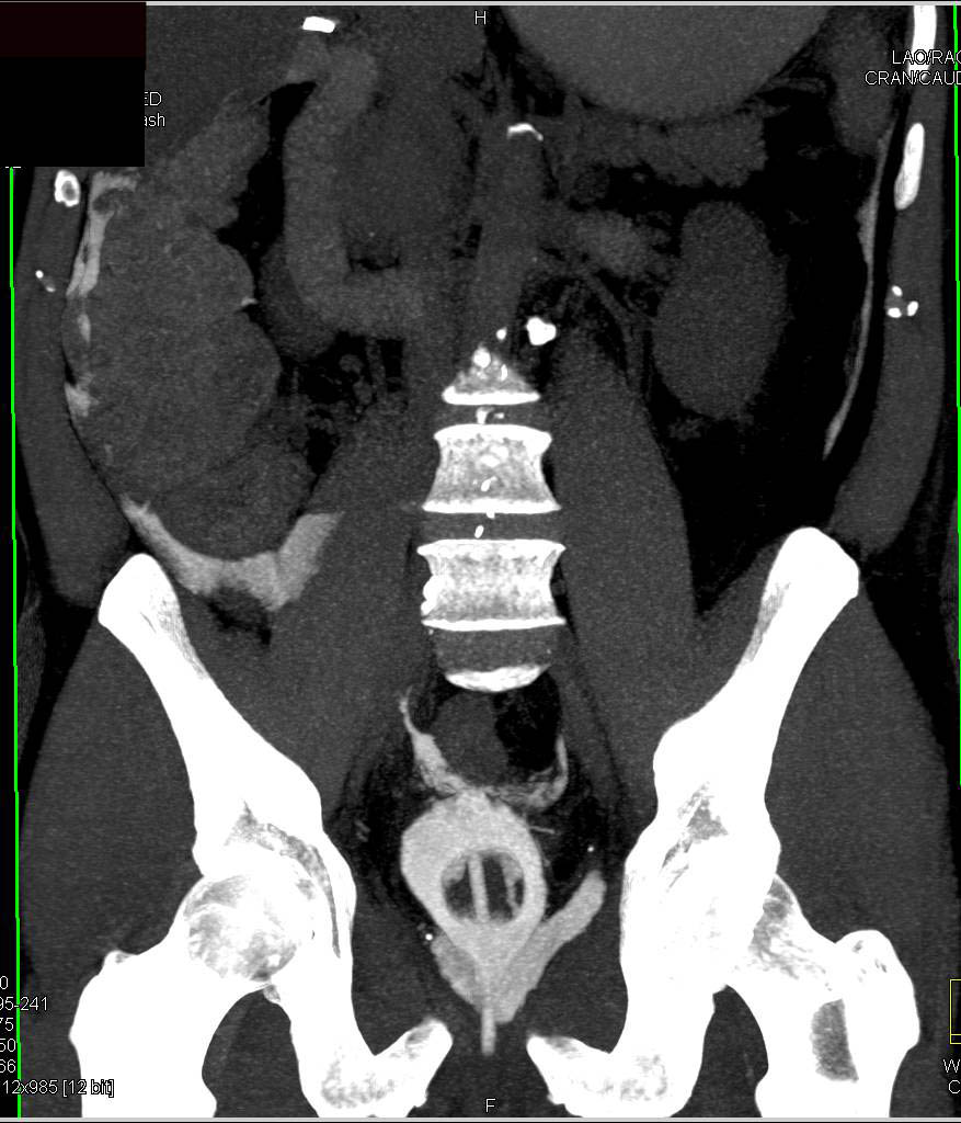 CT Cystogram with Leak s/p Laparoscopic Prostatectomy that is Intraperitoneal - CTisus CT Scan