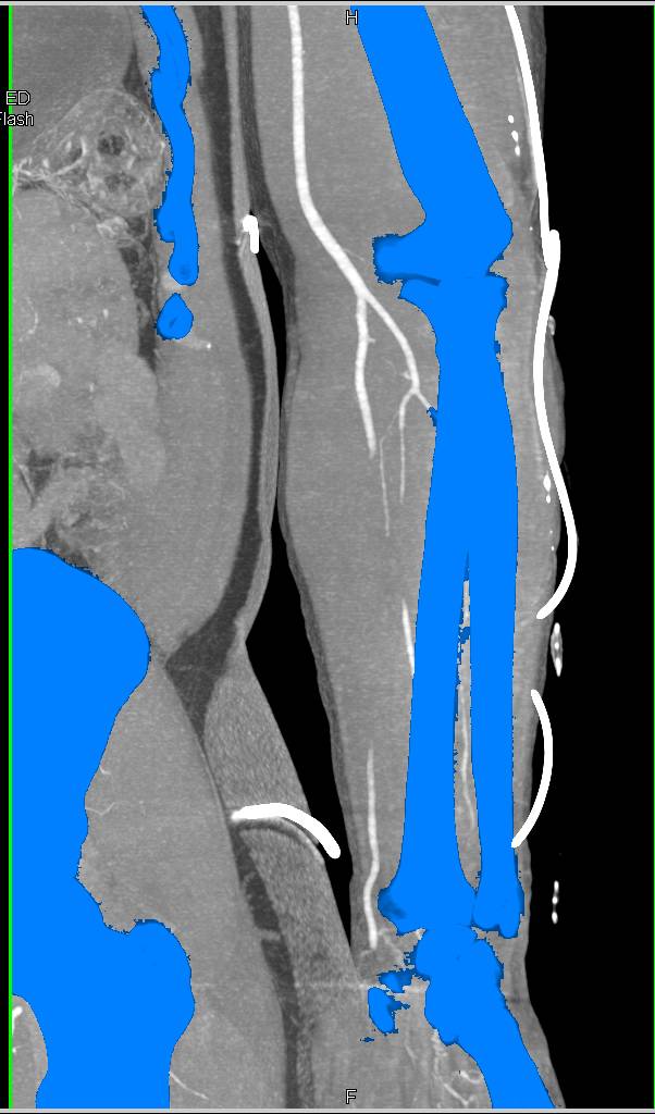 Trauma Forearm with Ulnar and Radial Artery Injury - CTisus CT Scan