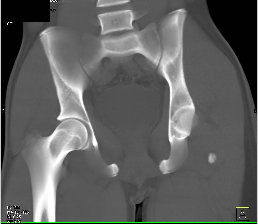 3D Mapping of the Pelvis and Acetabulum - CTisus CT Scan