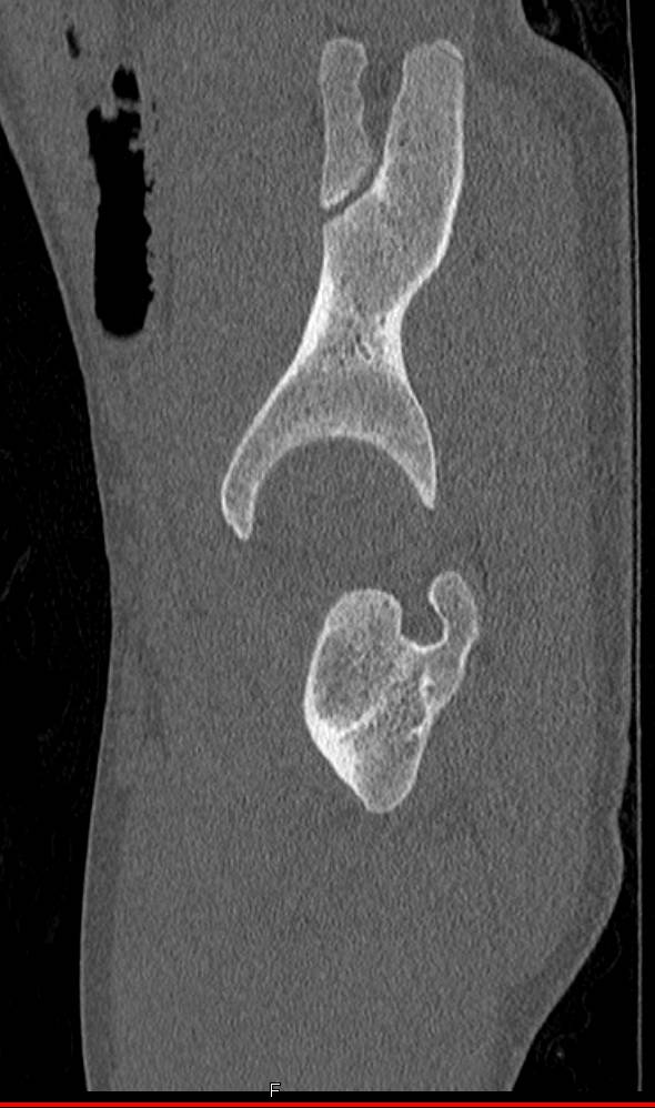 Right Hip Dislocation in 3D - CTisus CT Scan