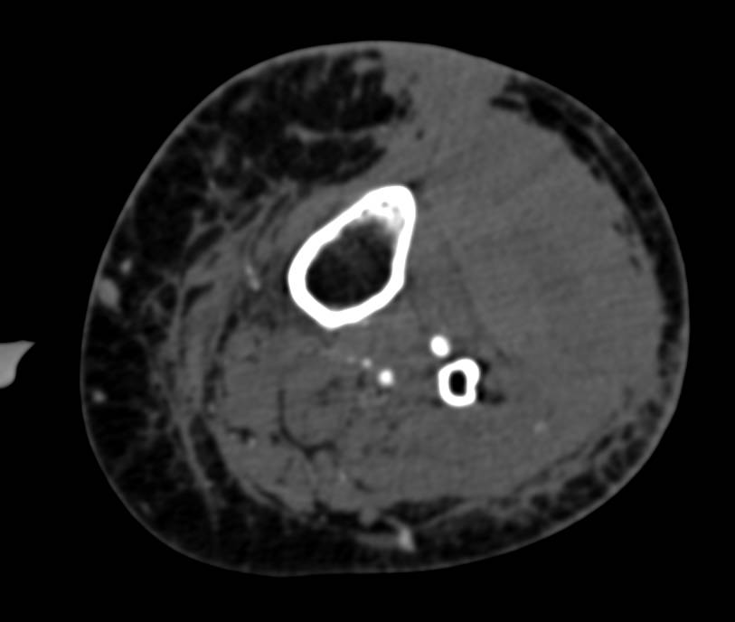 Trauma with Active Bleed Left Calf - CTisus CT Scan