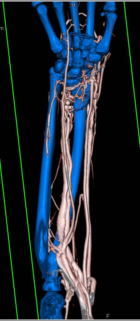 Arteriovenous (AV) Fistulae at the Wrist in 3D Display - CTisus CT Scan