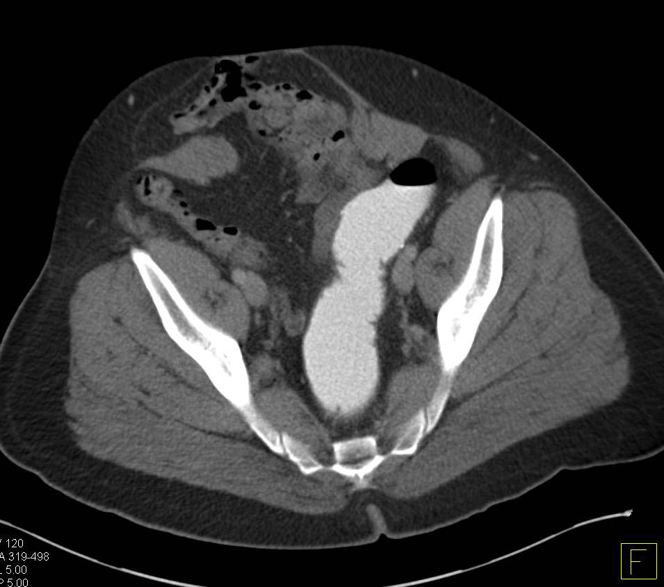 Use of Rectal Contrast in Trauma CT - CTisus CT Scan
