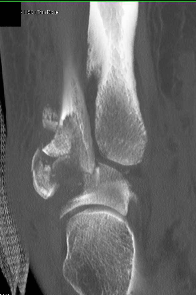 Comminuted Fracture with Dislocation - CTisus CT Scan