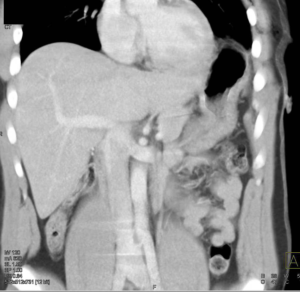 Trauma Left Chest with Diaphragm Injury - CTisus CT Scan