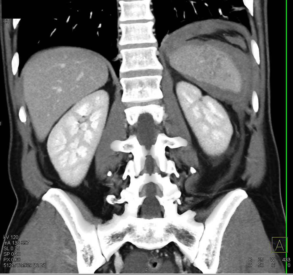 Splenic Laceration and Hemoperitoneum - CTisus CT Scan