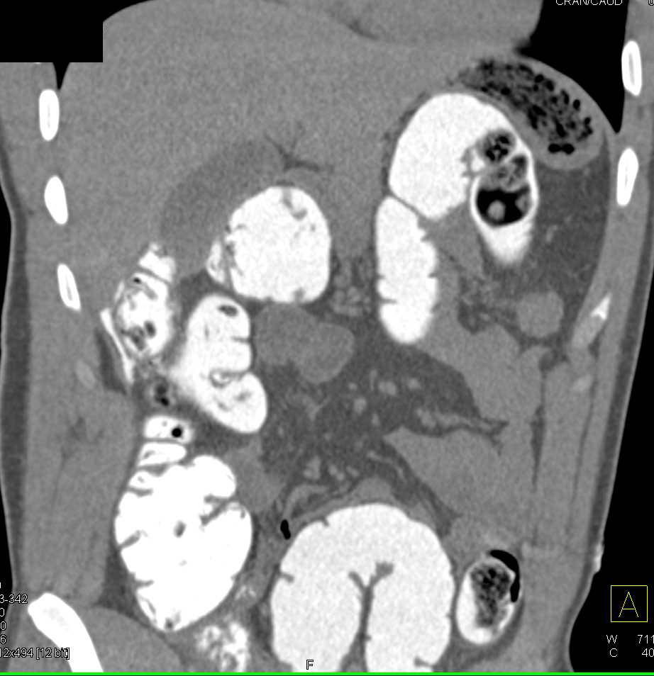 Rectal Contrast in Patient with Stab Wound Near Cecum and Subtle Contrast Extravasation due to Colon Injury - CTisus CT Scan