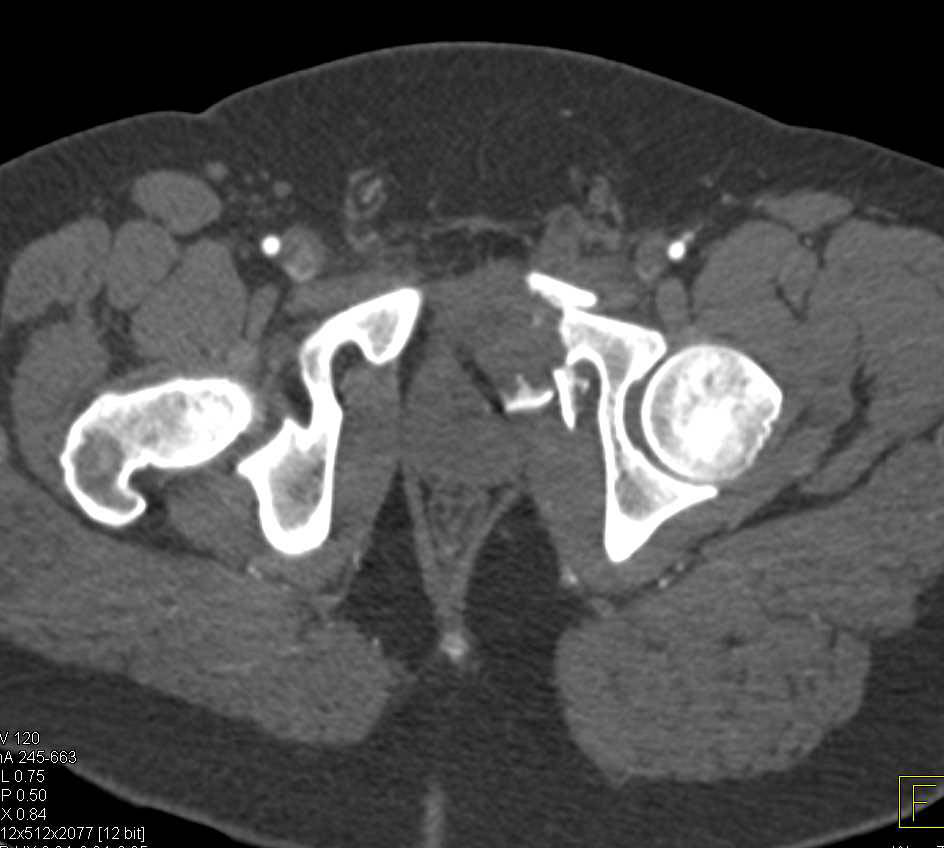 Complex Left Acetabular Fracture with L-Spine and Rib fFactures - CTisus CT Scan