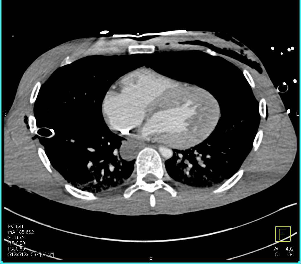 GSW with Multiple Sites of Bleeding Including Right Cervical Region and Liver - CTisus CT Scan