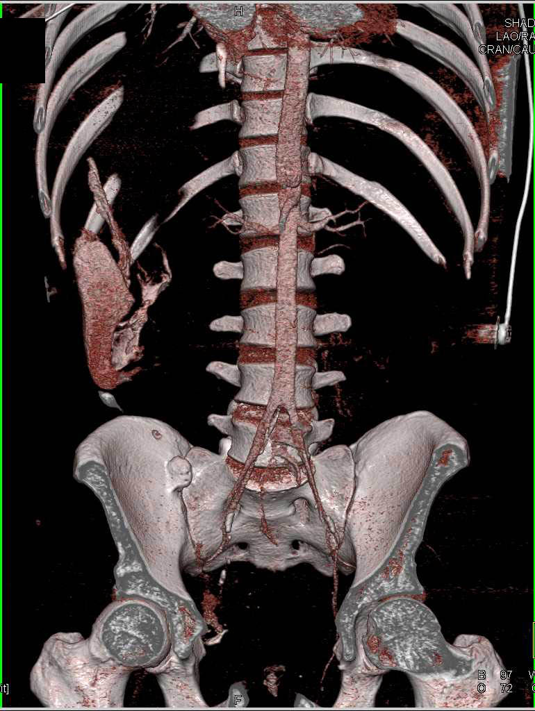 GSW with Multiple Sites of Bleeding Including Right Cervical Region and Liver - CTisus CT Scan