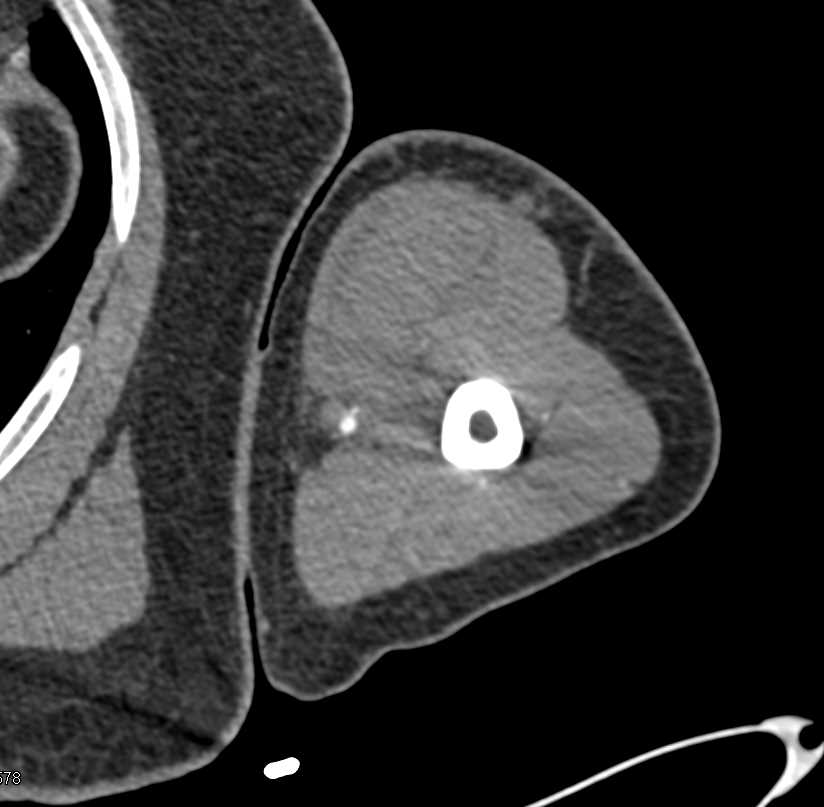 Normal CTA Arm s/p Trauma - CTisus CT Scan