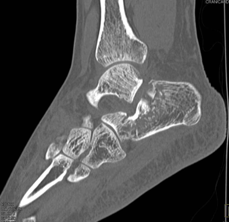 Comminuted Calcaneal Fracture - CTisus CT Scan