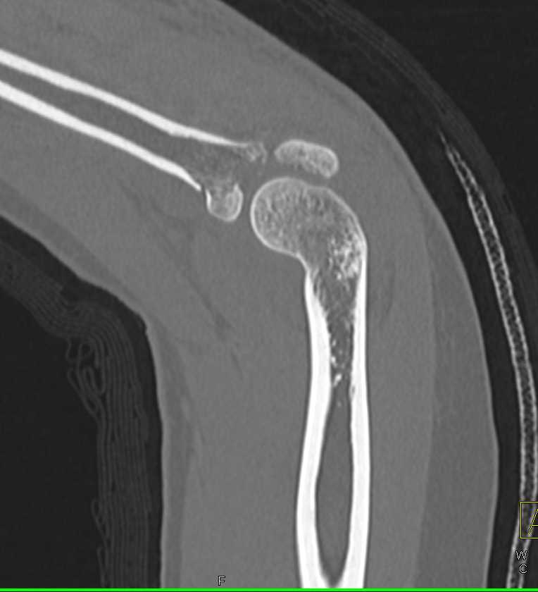 3D Radial Head Fracture - Trauma Case Studies - CTisus CT Scanning