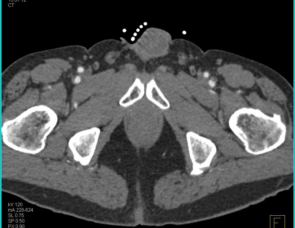 GSW Near Left Posterior Knee Fossa with Occlusion of Distal Superficial Femoral Artery (SFA) and Popliteal Artery - CTisus CT Scan