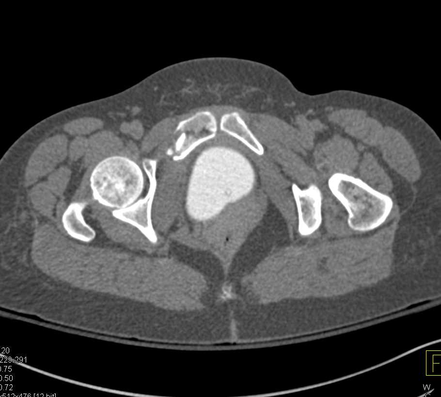 Pelvic Fractures with Normal CT Cystogram - CTisus CT Scan