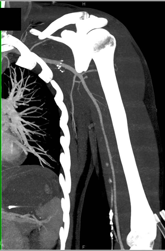 CTA Axillary Zone S/P GSW Without Vascular Injury - CTisus CT Scan