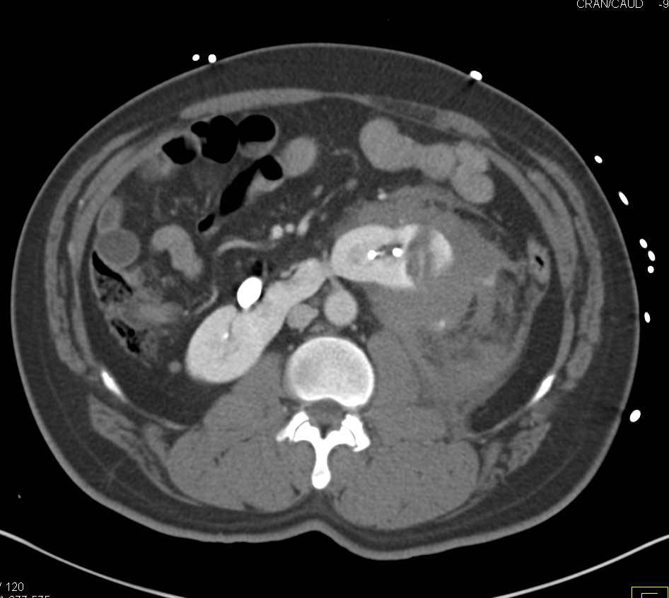 Renal Laceration with Perirenal Blood - CTisus CT Scan