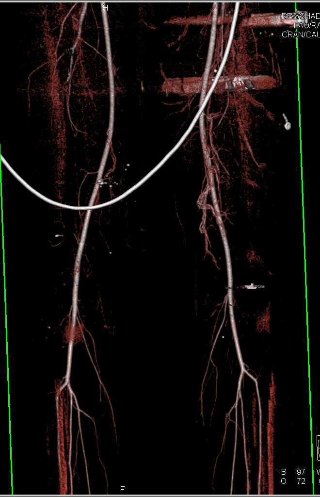 Multiple GSW Lower Extremities Without Contrast Extravasation - CTisus CT Scan