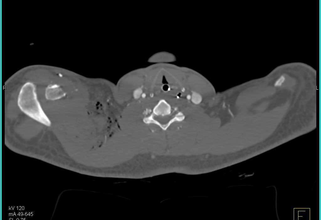 Multiorgan Trauma with Active Bleed in Abdomen on CTA - CTisus CT Scan