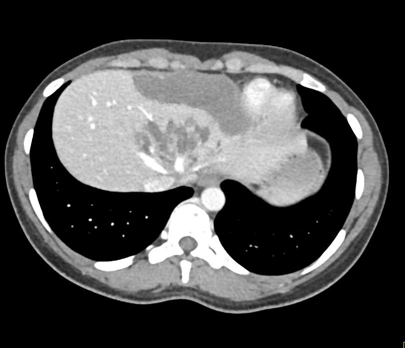 Multiple Hepatic Lacerations Following Trauma - CTisus CT Scan