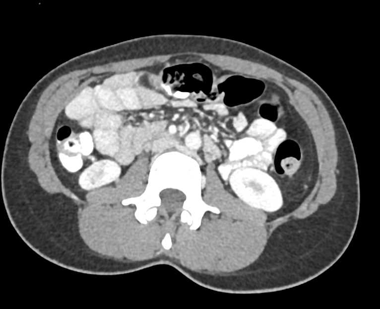 Multiple Hepatic Lacerations Following Trauma - CTisus CT Scan