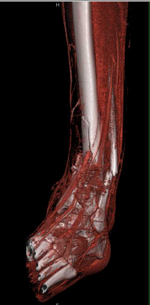 comminuted open fracture leg
