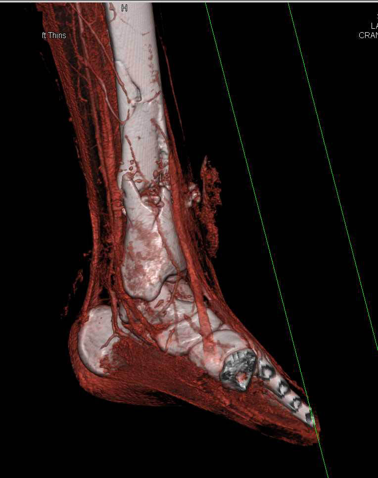proximal tib fib fracture comminuted