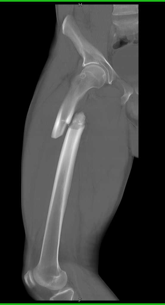 Spiral Femur Fracture Trauma Case Studies CTisus CT Scanning