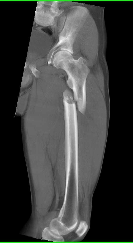 spiral-femur-fracture-trauma-case-studies-ctisus-ct-scanning