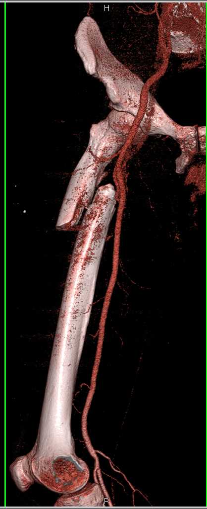 Femur Fracture Without Vascular Injury - CTisus CT Scan