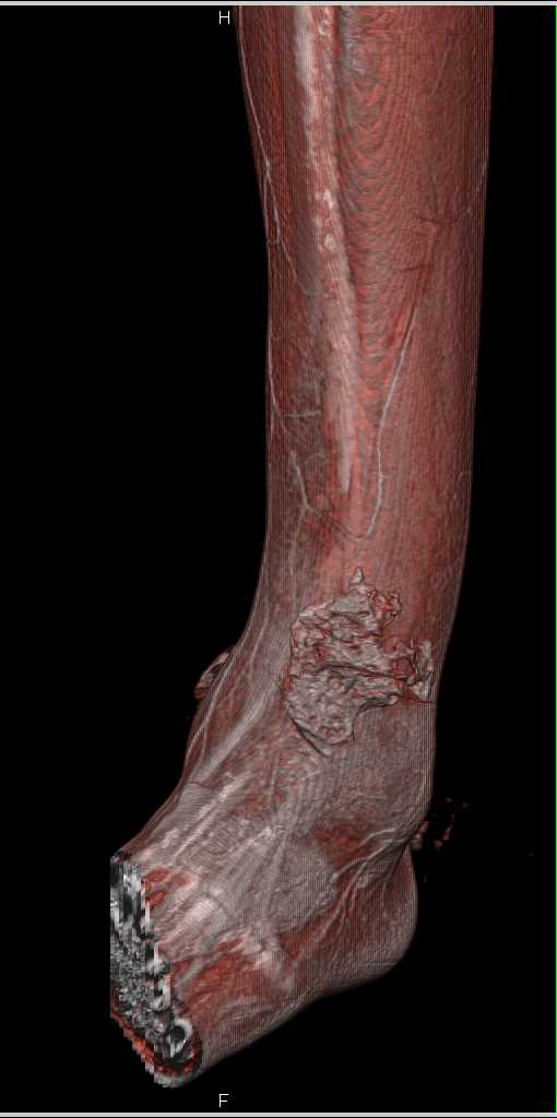 GSW Lower Leg with Bone and Muscle Injury - CTisus CT Scan