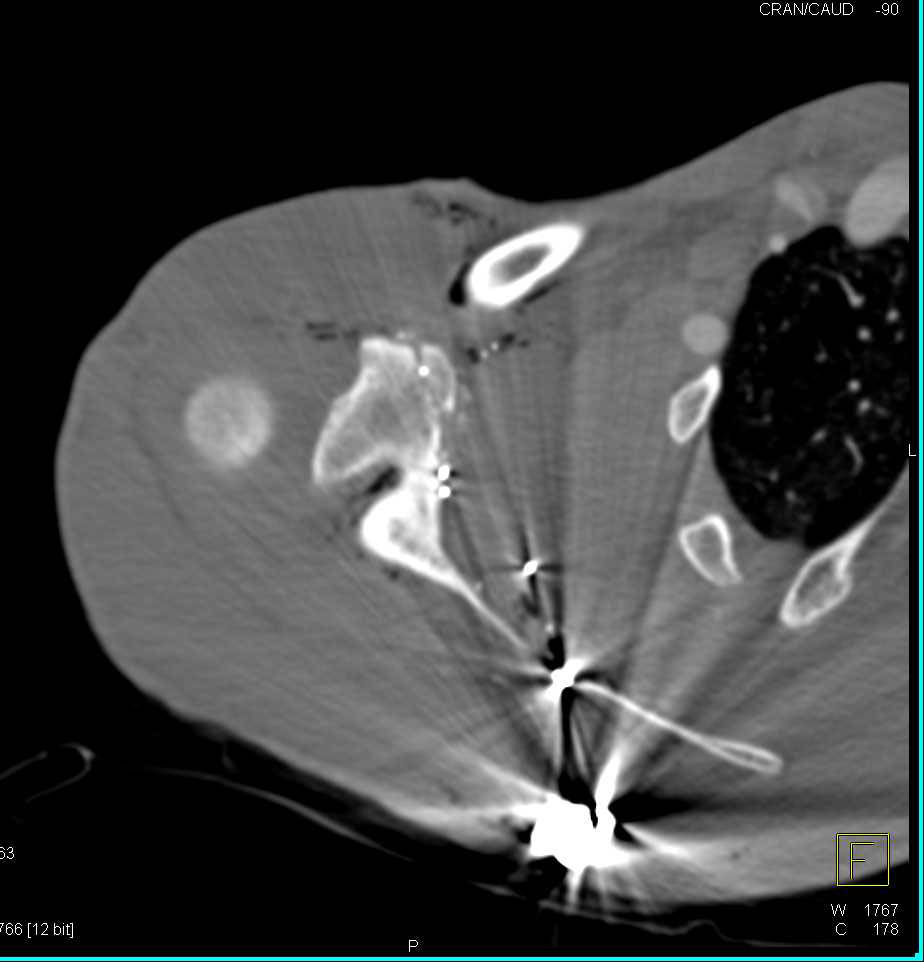 GSW Right Shoulder with Scapular Fracture - CTisus CT Scan