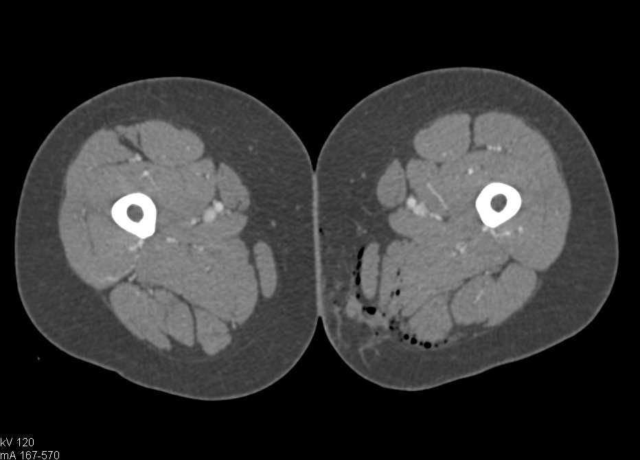 GSW Thigh Without Active Bleed with CTA - CTisus CT Scan