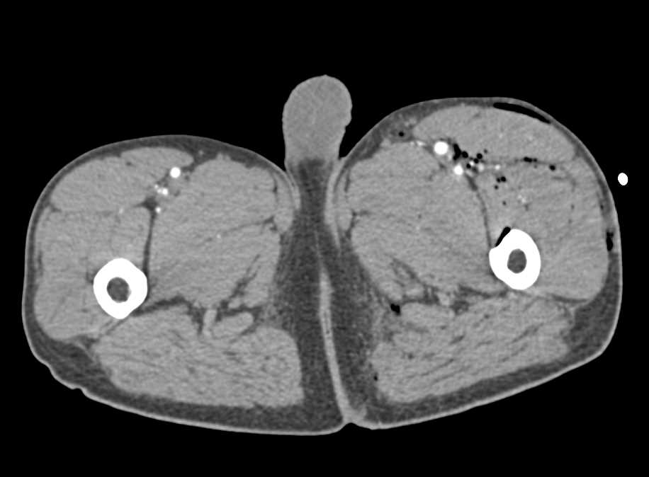 GSW Thigh with Muscle Injury but No Vascular Injury - CTisus CT Scan