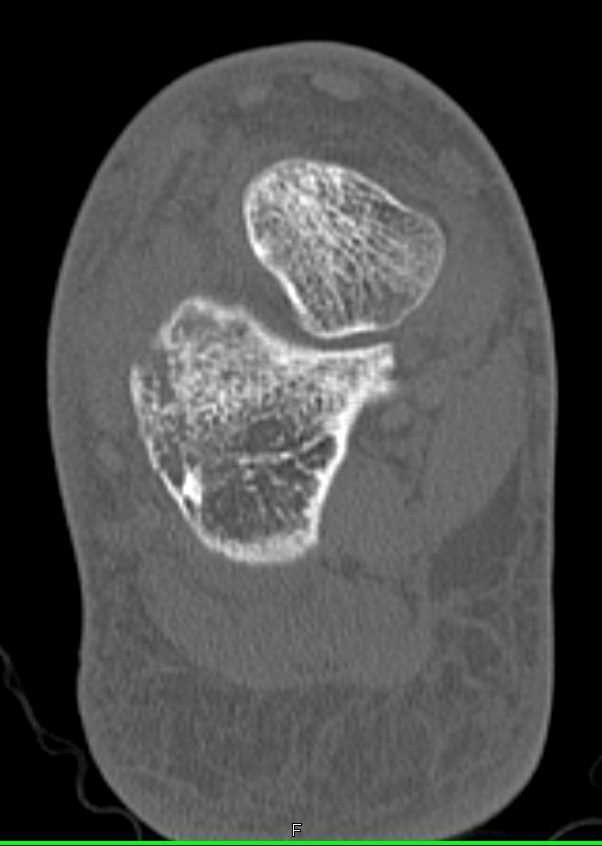 Fracture of the Calcaneus - CTisus CT Scan