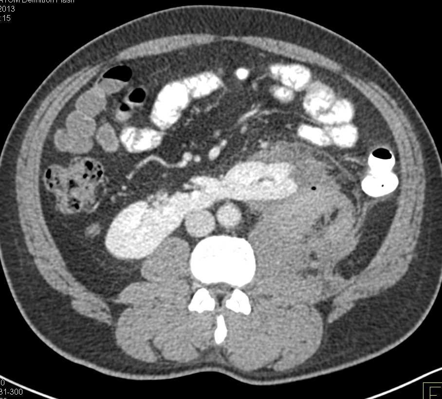 Left Renal Laceration with Hematoma and Contrast Extravasation - CTisus CT Scan